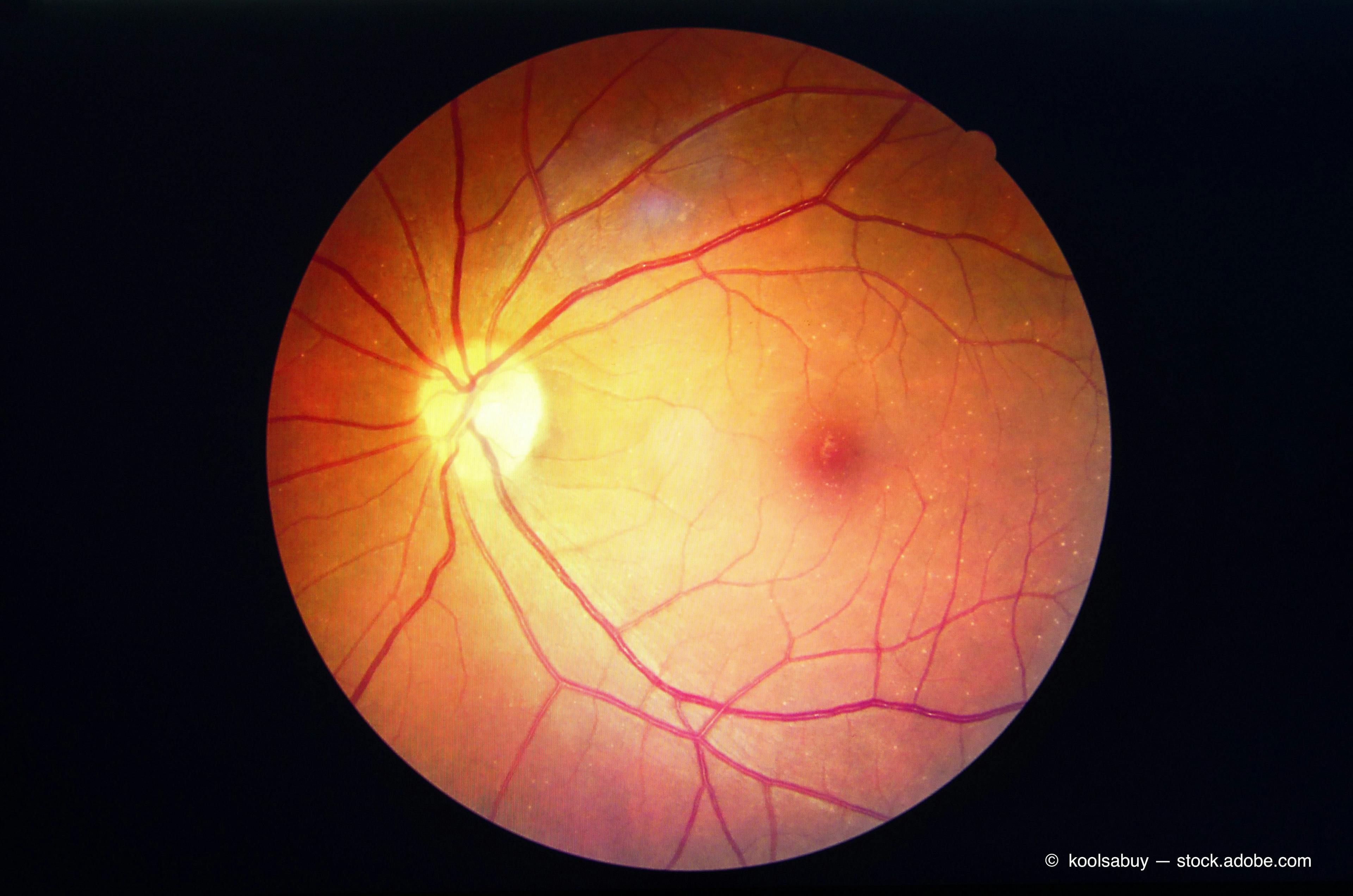 diabetic retinopathy 