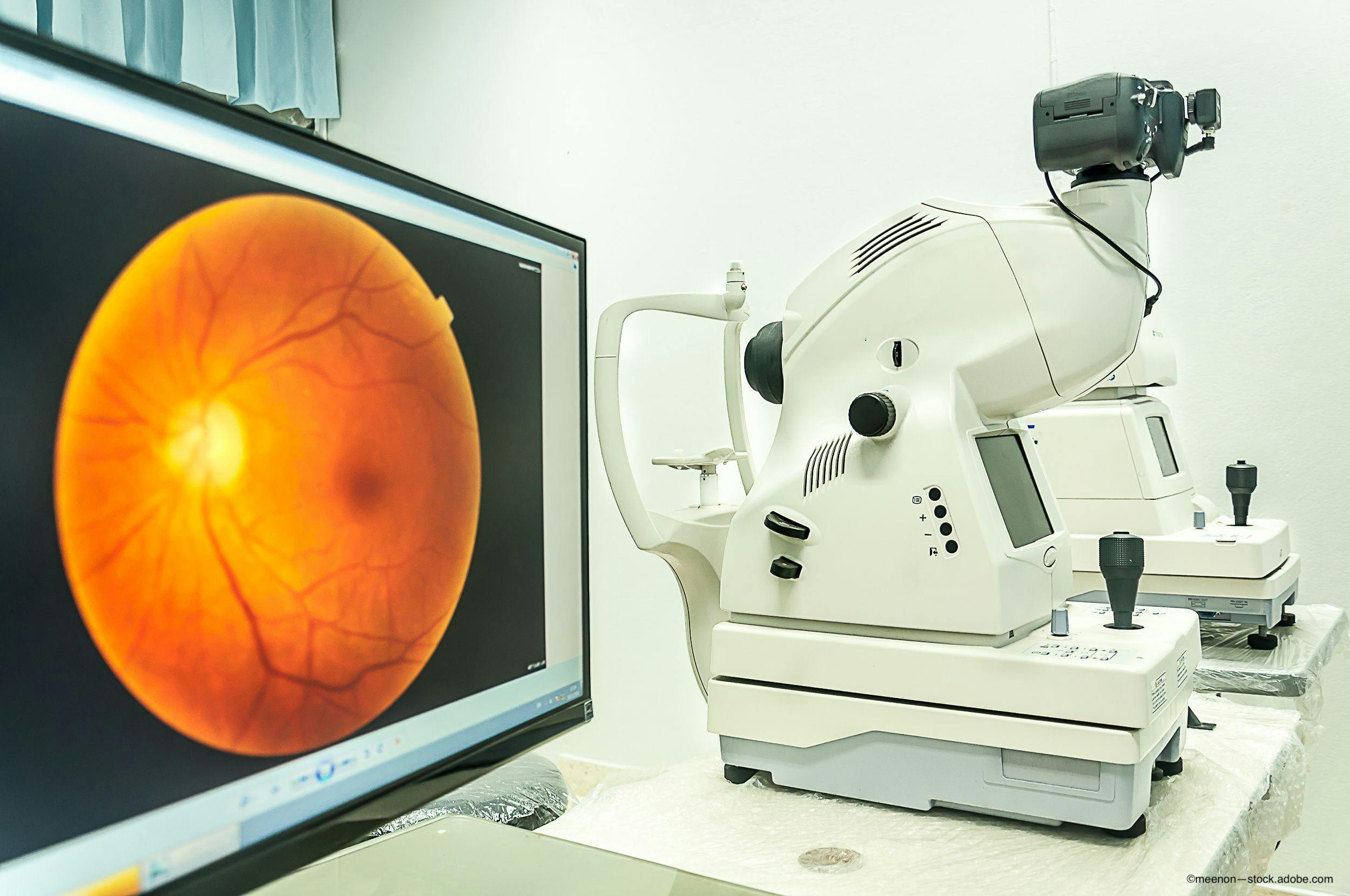 Dry AMD treatment facilitated by swept-source OCT imaging