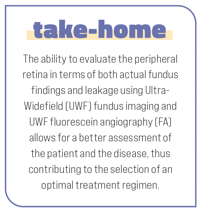 The ability to evaluate the peripheral retina in terms of both actual fundus findings and leakage using Ultra- Widefield (UWF) fundus imaging and UWF fluorescein angiography (FA) allows for a better assessment of the patient and the disease, thus contributing to the selection of an optimal treatment regimen.